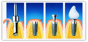 Implantologie-2-Fortuna-Dent