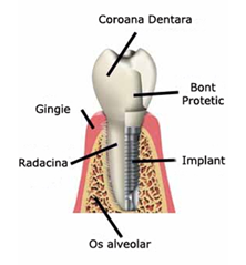 Implantologie-Fortuna-Dent